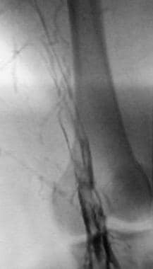 Lower-extremity venogram shows outlining of an acu