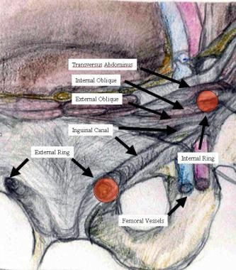 A) The left inguinal hernia sac is opened, revealing a sliding sigmoid