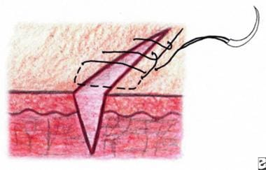 Running Locking Stitch