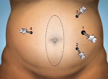 Port placement, trocar sizes and intraoperative setting. The ports in