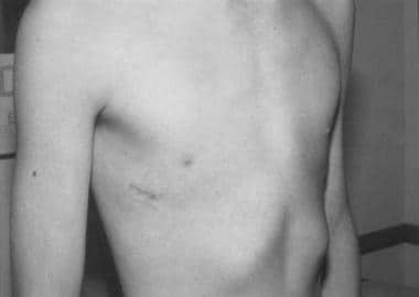A 12-year-old boy 2 weeks after minimally invasive