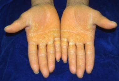 Palmar hyperkeratosis. 