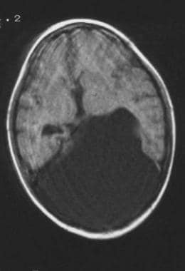 MRI in a patient with Nijmegen breakage syndrome. 