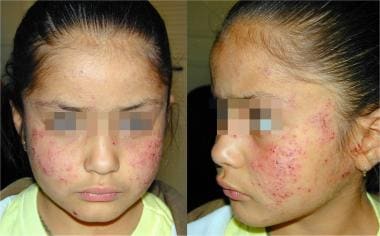 Young girl with a history of atopic dermatitis and