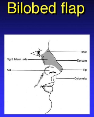 Anatomic areas where a bilobed flap may be used. 