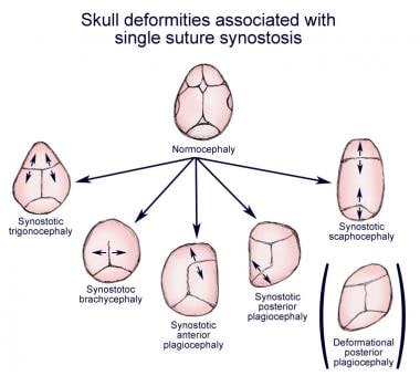 Skull deformities associated with single suture sy