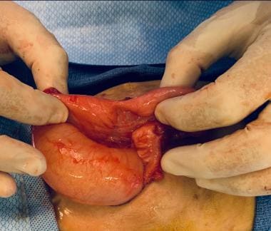 Intestinal obstruction in the newborn. A stricture