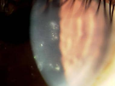 The cornea of a 33-year-old African American man w