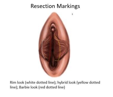 Labiaplasty resection markings. 