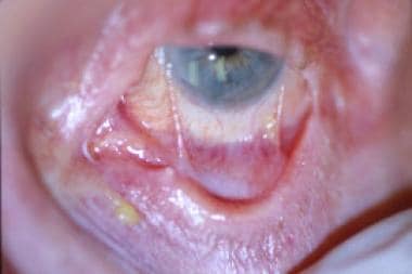 Ocular cicatricial pemphigoid, symblepharon format