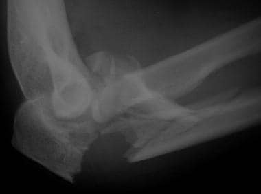 Monteggia-variant fracture-dislocation: olecranon 