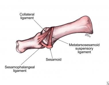 Lateral view of first metatarsophalangeal joint wi