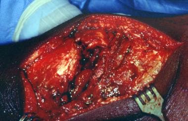 Exposure of a tendon rupture. 