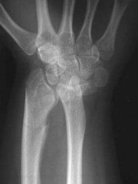 Preoperative posteroanterior radiograph of wrist f