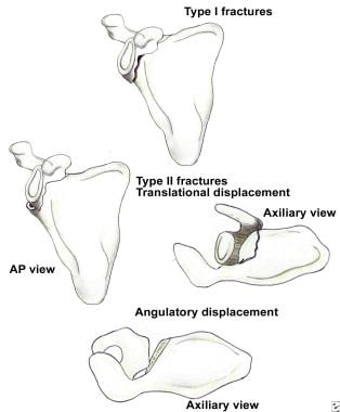 Scapula Fracture Treatment & Management: Approach Considerations ...