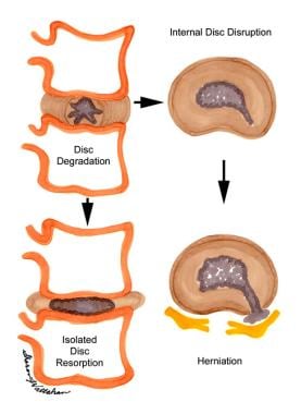 What Is Degenerative Disc Disease? - Orthopedic & Sports Medicine