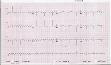 A 12-Lead electrocardiogram of typical atrial flut