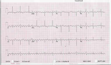 Atrial Flutter Sawtooth Ecg