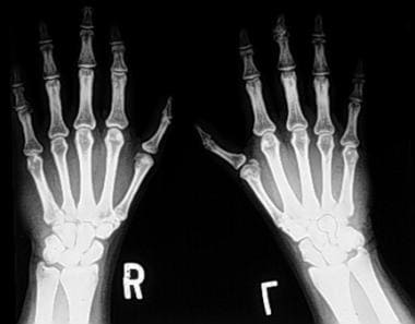 Holt-Oram Syndrome. Posteroanterior radiograph of 