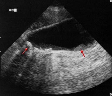 Sagittal ultrasonogram in a 71-year-old woman. Thi