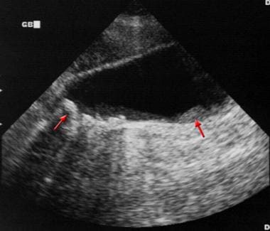 gallbladder ultrasound cancer