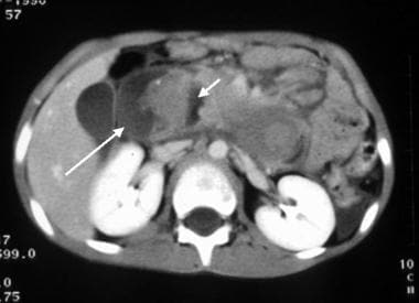 Computed tomography (CT) image of duodenal hematom