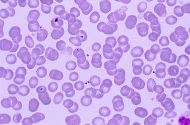 Malarial merozoites in the peripheral blood. Note 