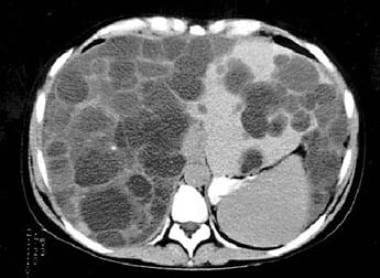 Polycystic kidney disease and massive polycystic l