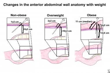 Gynecologic laparoscopy. Changes in the anterior a