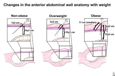 Port placement, trocar sizes and intraoperative setting. The ports in