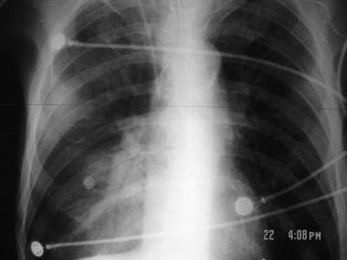 A 40-year-old patient with Chlamydia pneumonia. Ch