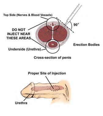 High Blood Pressure and Erectile Dysfunction, Department of Surgery