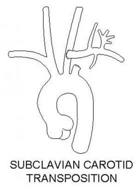 Subclavian transposition. 