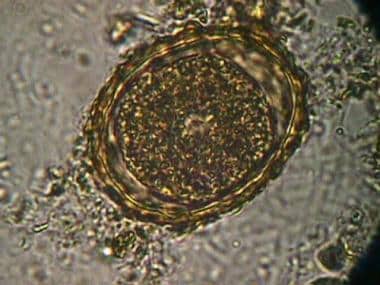
Ascaris lumbricoides egg in feces (formalin-ethyl
