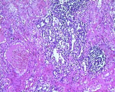 Empyema and Abscess Pneumonia. Histology of a lung