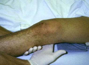 Knee Dislocation Treatment \u0026 Management 