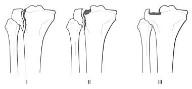 Tibia And Fibula Fracture In The Ed Clinical Presentation History