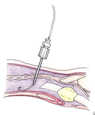 Percutaneous dilatational tracheotomy (PDT techniq