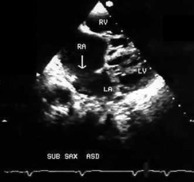A 2-dimensional echocardiographic picture taken fr