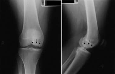 Anteroposterior and lateral radiographs of medial 