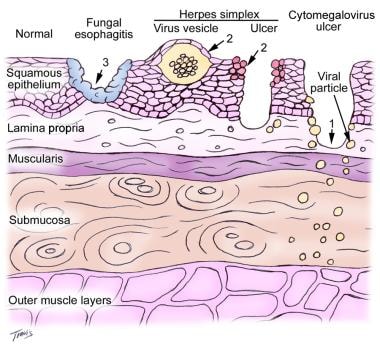 Location of fungal and viral infections in ulcers.