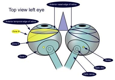 Retinopathy of Prematurity. Zone III retinopathy o