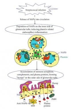 glomerulonephritis pathophysiology