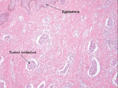 Two types of breast carcinomas based on a structural pattern