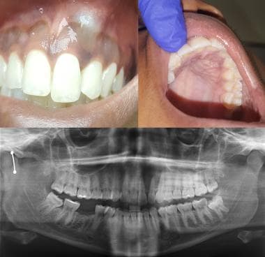 Cystic cavity lined by nonkeratinized stratified squamous