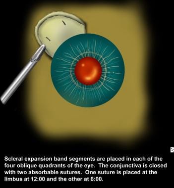 Placement of the polymethyl methacrylate band. 