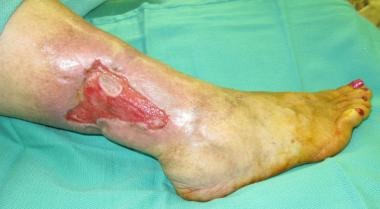 Nonhealing lower extremity wound. 