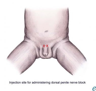 Injection sites for dorsal penile nerve block. 