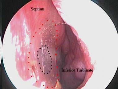 Endoscopic view of a nasal septal button from the 