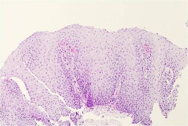 Histology from a patient with reflux esophagitis.